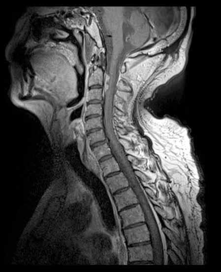 of the spinal cord. (C) Sagittal contrast-enhanced T1-weighted image shows an intense contrast enhancement of the masses, consistent with metastatic disease. limb with biofeedback.
