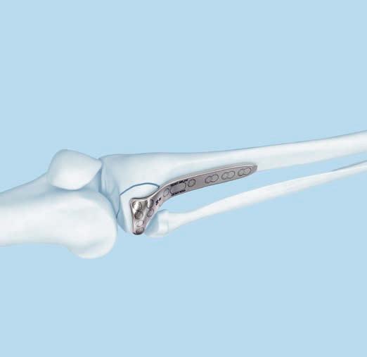 Plate Insertion and Fixation 1. Determine plate type Instruments 03.127.012 Trial Implant for VA-LCP Proximal Tibial Plate 3.5, Small Bend, right, with 6 marked holes 03.127.013 Trial Implant for VA-LCP Proximal Tibial Plate 3.