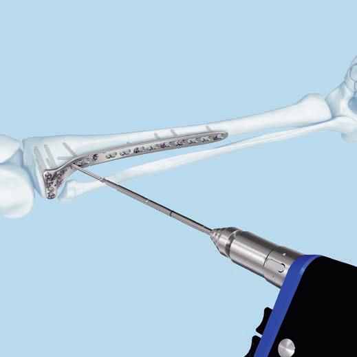 Insert a VA fixed angle drill guide into the proximal neck hole and follow the procedure described in Step 1.