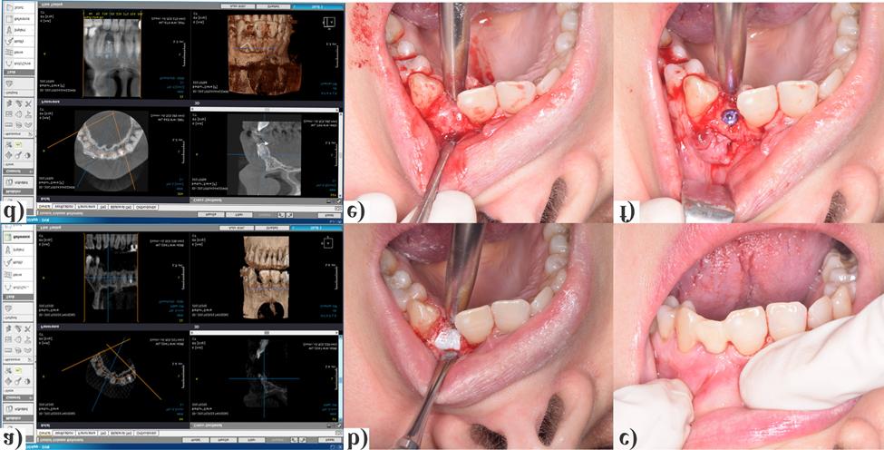 Case report: a) preoperative CBCT; b) the Ti-PTFE membrane in place; c) the provisional bridge; d) postoperative CBCT; e) the new bone offer after 8 months and f) the implant in place. Table 1.
