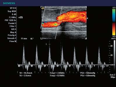 Pulsed-Wave Doppler Excellent Doppler sensitivity provides accurate graphical representation of blood flow.