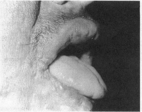 252 Sandi pan Dhar et al. Figure 2. (Close up) Infiltrated papules and nodules over lips, lateral border and dorsum of the tongue (Case I). areas looking normal (Figure 3).