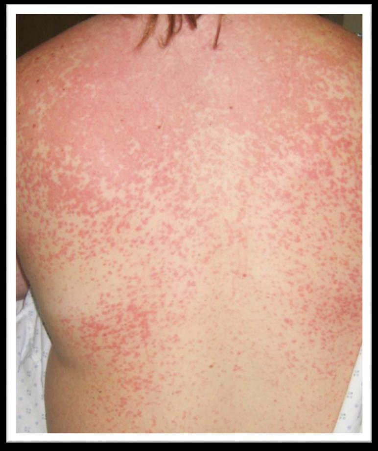 Epstein-Barr Virus (HHV-4) Generalized, pruritic, erythematous to coppercolored macules 7-10 days after starting