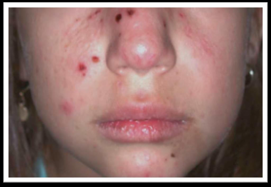 Epstein-Barr Virus (HHV-4) Childhood-onset photodermatosis