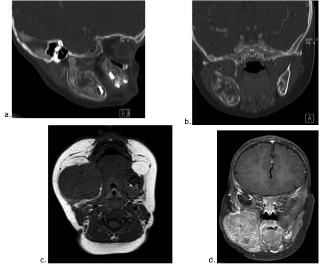 Fig. 6: Ewing sarcoma of the right mandible in a 1-year old girl with a progressive right facial mass. (a.) Sagital and (b.