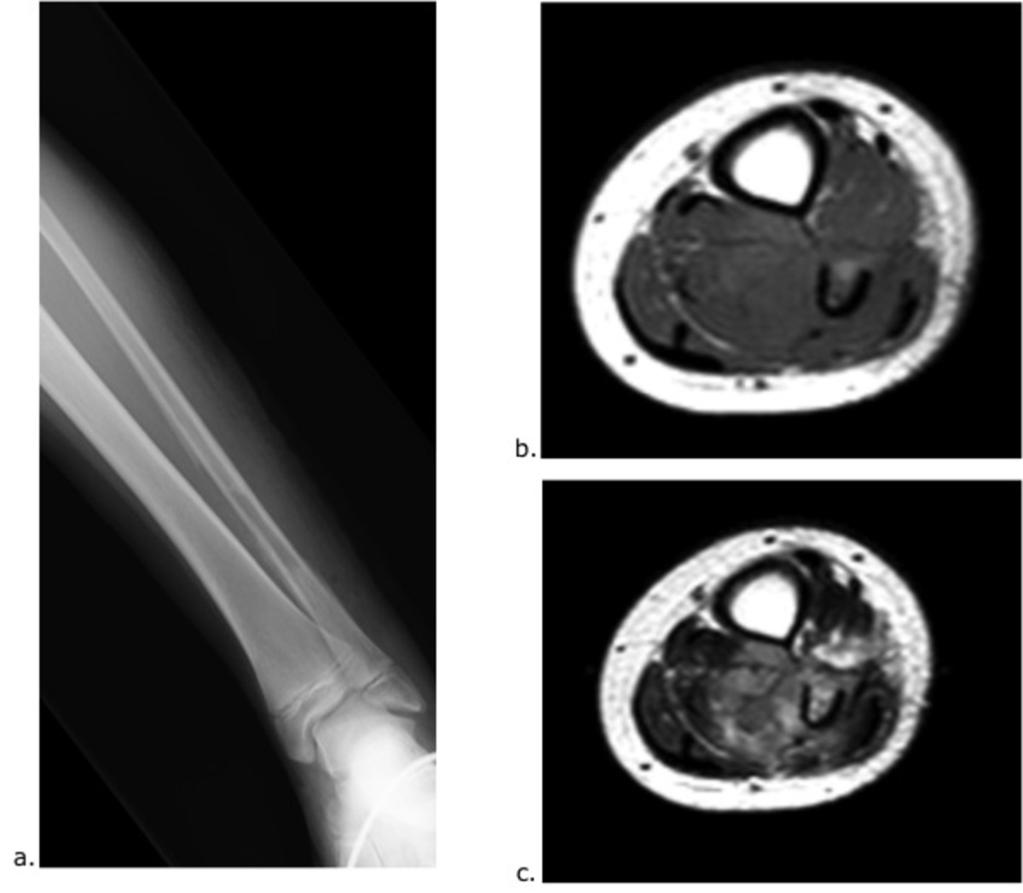 Fig. 2: Ewing sarcoma of the proximal left humeral metadiaphysis in a 16-year old boy with pain and enlarging mass in the left proximal upper extremity. (a.
