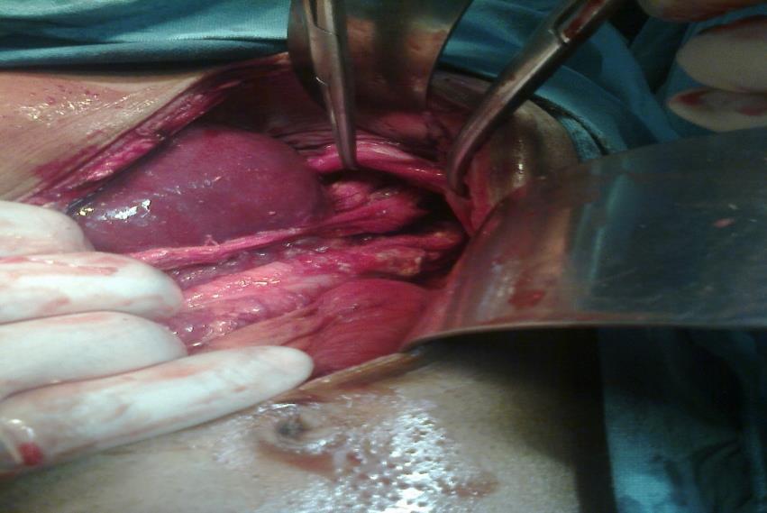 Figure: 6. Intraoperative photo showing herniation of stomach and bowel. REFERENCES [1] Cribbs RK, Gow KW, Wulkan ML. Gastric volvulus in infants and children. Pediatrics 2008,122(3):e752-62.