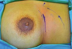 Plastic Surgery International 3 (a) (b) (c) (d) Figure 1: (a) Diagram showing the skin marking of the submammary incision.