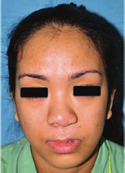 Plastic Surgery International 5 (a) (b) Figure 2: A 24-year-old lady with left unilateral cleft lip and palate.