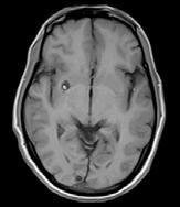 eccentric scolex within the brain parenchyma appearing hypointense on T2W images at