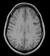 without any perilesional edema suggestive of neurocysticerosis in vesicular stage.