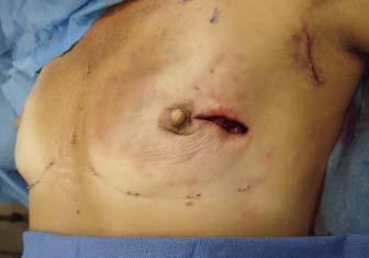 Breast Reconstruction Postmastectomy Patient profile A 39-year-old woman with a one centimeter invasive lobular carcinoma and several additional areas of ductal carcinoma in situ (DCIS) in the left