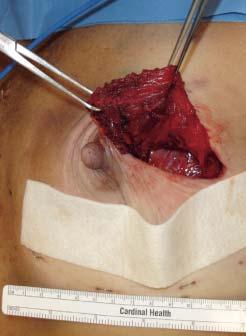 Once the patient was anesthetized and prepped, the IMF line was fixed by skin staples. The surgical oncologist then performed a left-sided nipple sparing mastectomy and sentinel node dissection.