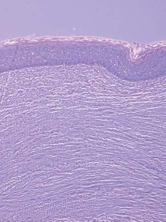 Histology slide of normal breast capsule Note the abundant collagen and extracellular matrix with a few blood vessels two