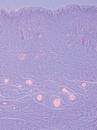 There is also a strong inflammatory reaction with a ridge of eosinophils and macrophages against the implant surface.