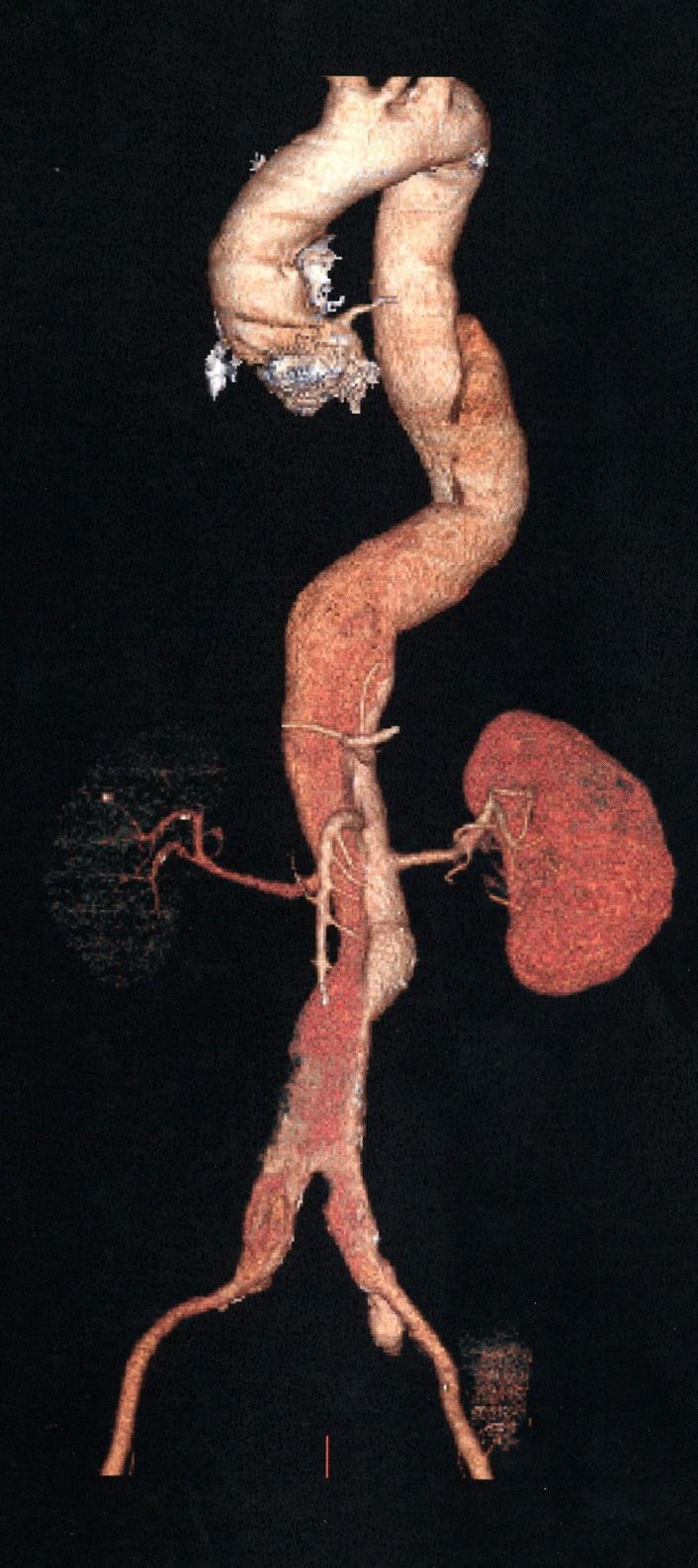 Detached ostium of the right renal artery. 1.