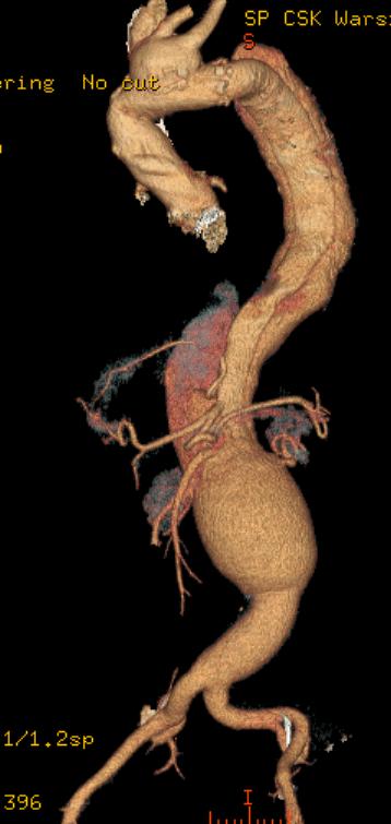 Case 7 Patient with Marfan syndrome after surgical repair of the ascending aorta and