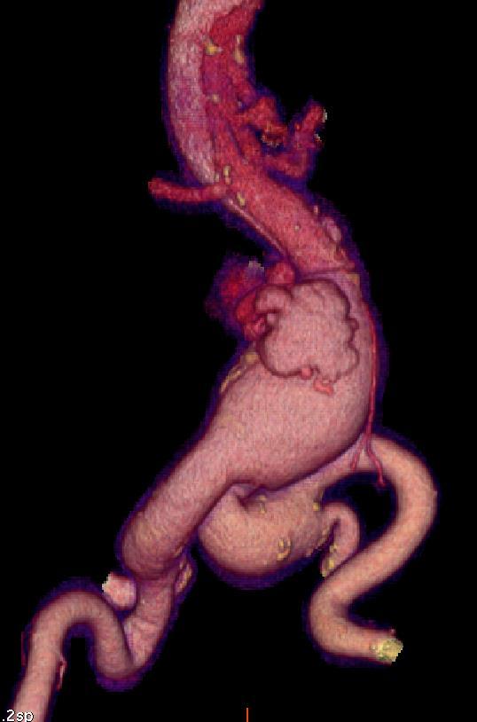 Case 9 Patient with abdominal aortic