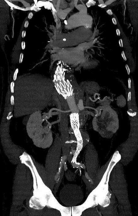 Case 10 Aortic dissection with