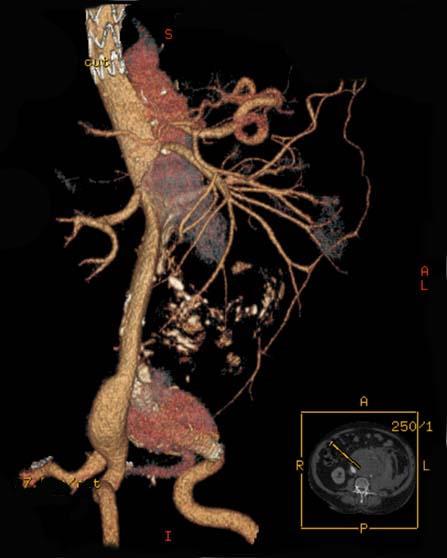 Case 12 62 years old patient. Dissection Type B. Left iliac artery aneurysm.
