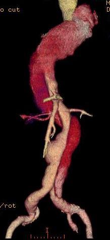 Case 13 Staged aortic and branch vessel endovascular repair.