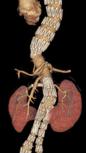 right renal artery