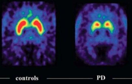 DaT Scan (Dopamine transporter scan) Most helpful in distinguishing Parkinson s disease from essential tremor or drug induced Parkinson s disease.