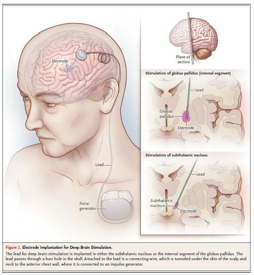 Deep Brain Stimulation (DBS) High frequency electrical stimulation of brain structures by electrodes surgically implanted deep inside the brain Mechanism of action: Disrupt the disruption FDA