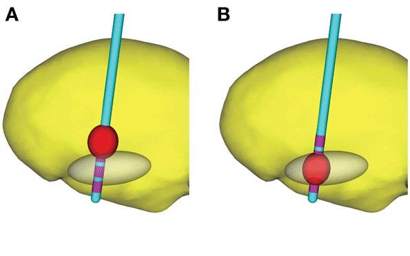 DBS electrode generates a precise region of