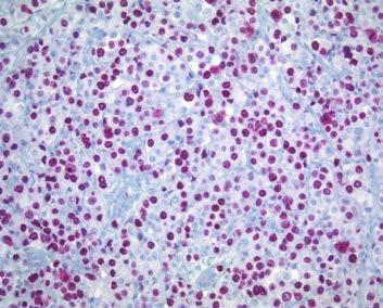 TNBC Pathologic Characteristics The classical histology High-grade IDC Triple-Negative High nuclear grade Mitoses Solid growth Event-Free Survival, % pcr no pcr High