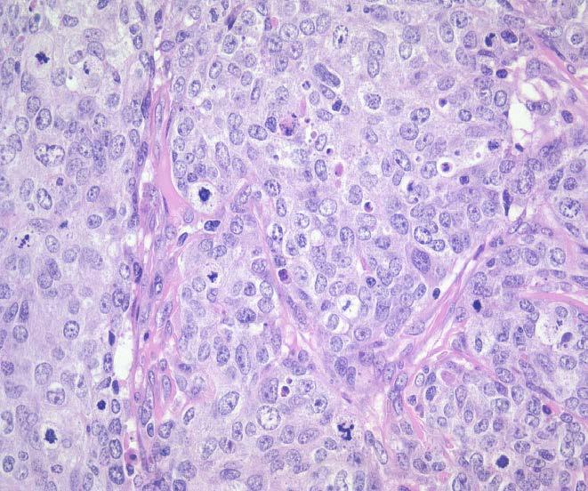 TNBC Special Situations The classical histology