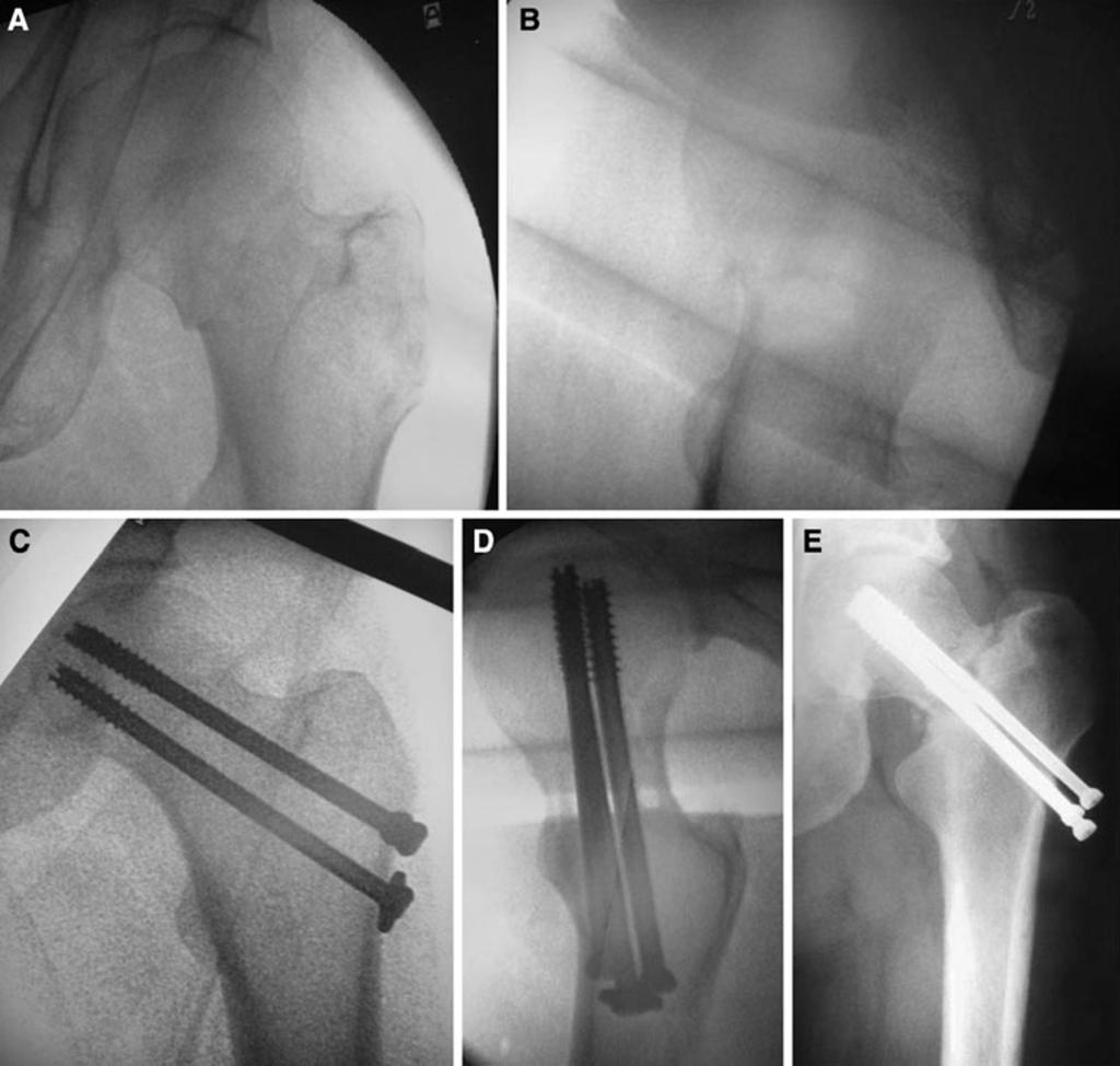 Strat Traum Limb Recon (2011) 6:7 12 9 Fig. 1 Intraoperative a anteroposterior and b lateral fluoroscopy views show a non-displaced Garden II femoral neck fracture in a 64-year-old woman.
