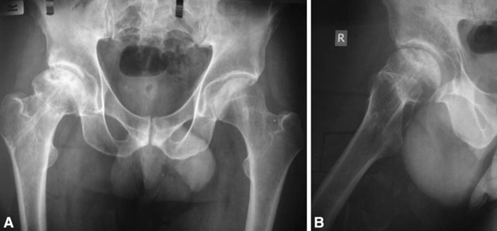 1 shows resorption of the femoral neck and lateral migration of the hip screws, suggesting non-union of the femoral neck fracture. Revision to total hip was done Fig.