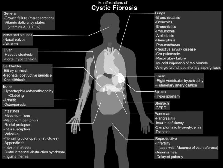 Symptoms of CF Symptoms of CF begin early in life and are often first seen in the respiratory tract or in the digestive tract.