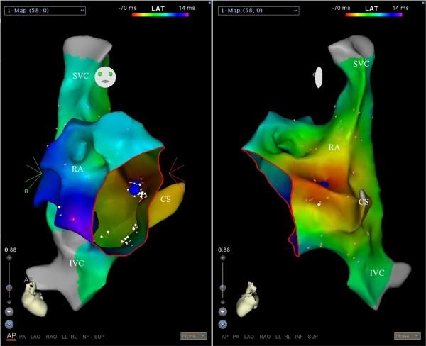 Koca S et al, Electroanatomic Mapping-Guided RF Ablation of Atrial Tachycardia 260 Figure 2.