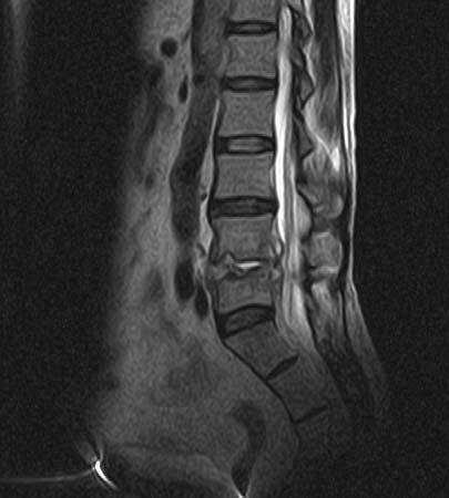 台灣老誌 Spondylodiscitis and Infective Endocarditis caused by 第 4 卷第 4 期 Figure 1 Plain spine radiograms revealed a wedge shape deformity at L5 vertebral body with bony erosion at superior end-plate.