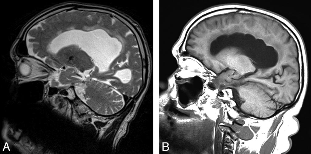 FIG 3. Two patients with focal bulging of the roof of the lateral ventricles. Sagittal images include the most cranial portions of the lateral ventricles. A, T2-weighted image. B, T1-weighted image.