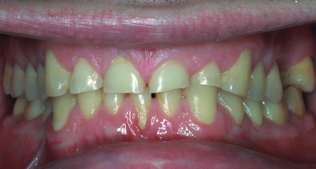 A personal perspective and update on erosive tooth wear 10 years on: Part 2 Restorative management D.