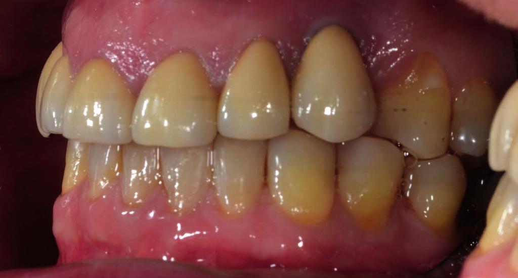 Fig. 5 Shows worn teeth when conventional crowns may be needed.