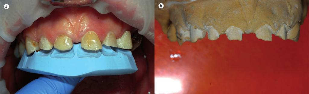 In this case, crown height is compromised and surgical crown lengthening was needed matrix can be used to facilitate the chair side composite build-ups.