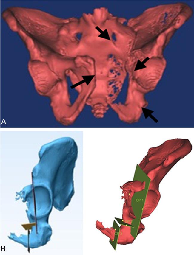 normal pelvic region and the pelvic tumor resection region. The surface characteristics of the residual acetabular osteotomy were extracted and the operative osteotomy plate was determined. Figure 2.