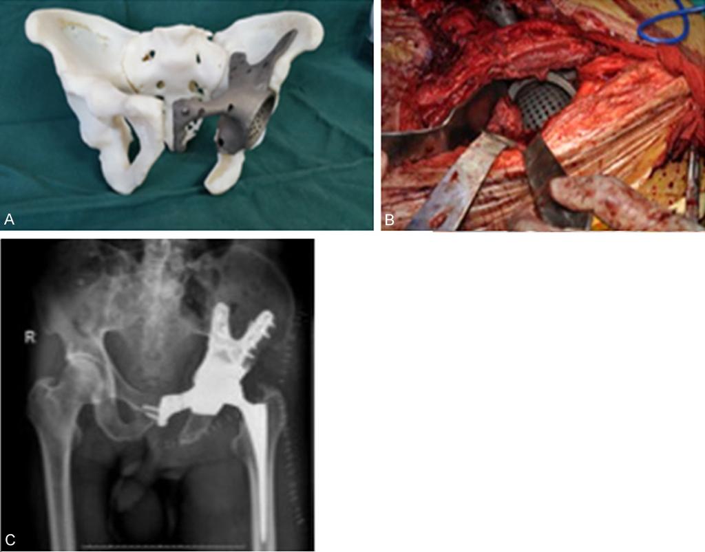Figure 4. The successful reconstruction (A) and installation (B) of pelvic 3D model and titanium alloy metal prosthesis preoperatively and confirmation with postoperative X-ray (C).