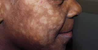 Upon further questioning, family members reported an antecedent pruritic papulovesicular eruption of the involved areas as well as concomitant cough, rhinorrhea, diminished appetite, and fever.