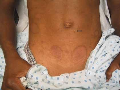 hypopigmentation was the predominant clinical feature. In at least 4 of our cases (patients 1, 2, 3, 5), the diagnosis of PLC was not entertained at the initial presentation.