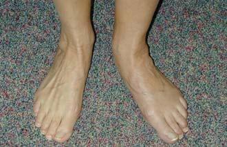 planus Pes cavovarus Low arch Medial tenderness/swelling