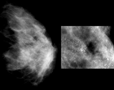 Caumo F et al / Radiologic-pathologic correlation of inflammatory breast cancer 279 Figure 4. Inflammatory carcinoma, uncommon presentation.