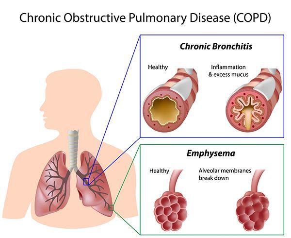 Pathophysiology Chronic productive cough for at least 3 consecutive months in 2 consecutive years (driven by chronic