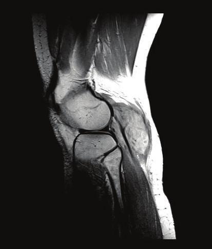 2 Case Reports in Surgery Figure 3: Intraoperative picture: 1 tibial nerve, 2 common peroneal nerves. Figure 1: MRI scan, sagittal view.