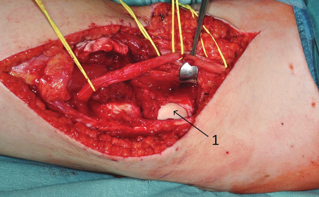 We found the communal peroneal nerve surrounded by the superficial portion of the desmoid tumor and it was mobilized to get a representative biopsy of 1 cm3.