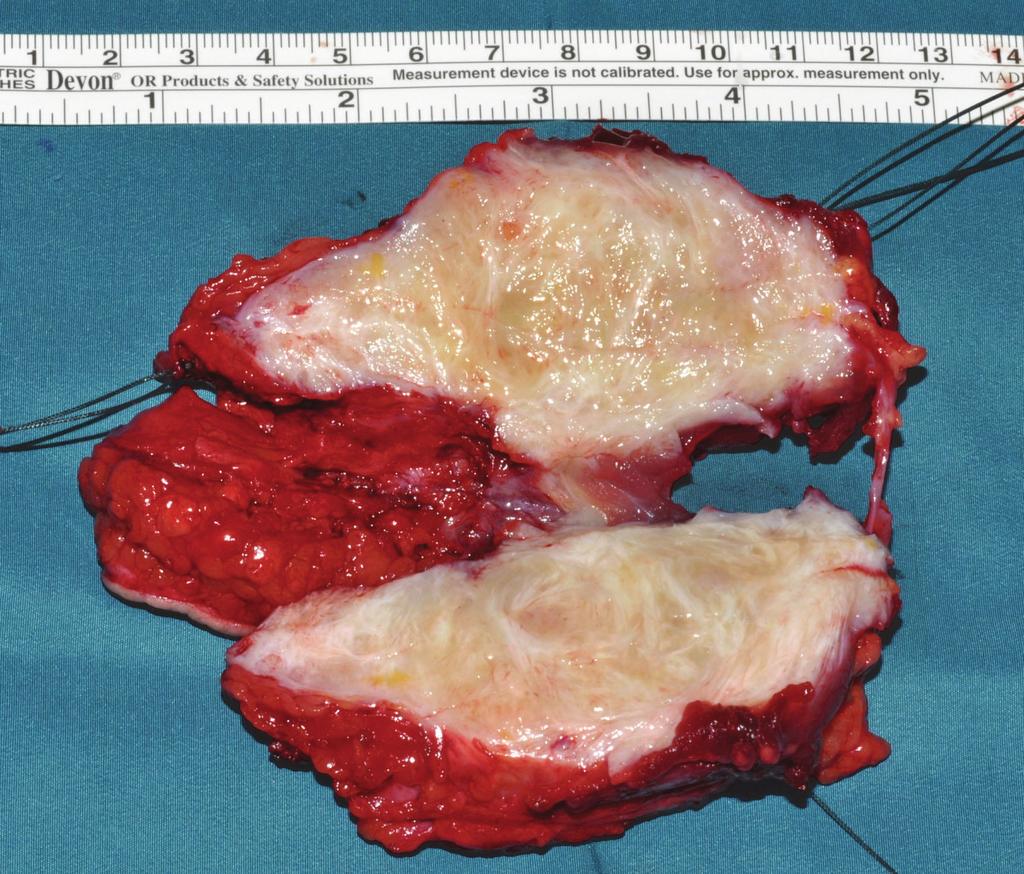 The communal peroneal nerve was surrounded by tumor 6 cm in length and had to be dissected, even though the tibial nerve was displaced by the desmoid tumor (see Figures 3 6).